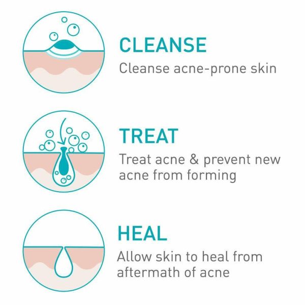 2* Cerave Acne Treatment Foaming Cream Face Cleanser 4% Benzoyl Peroxide 150ml New